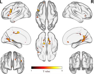 High-Frequency Hearing Loss Is Associated With Anxiety and Brain Structural Plasticity in Older Adults